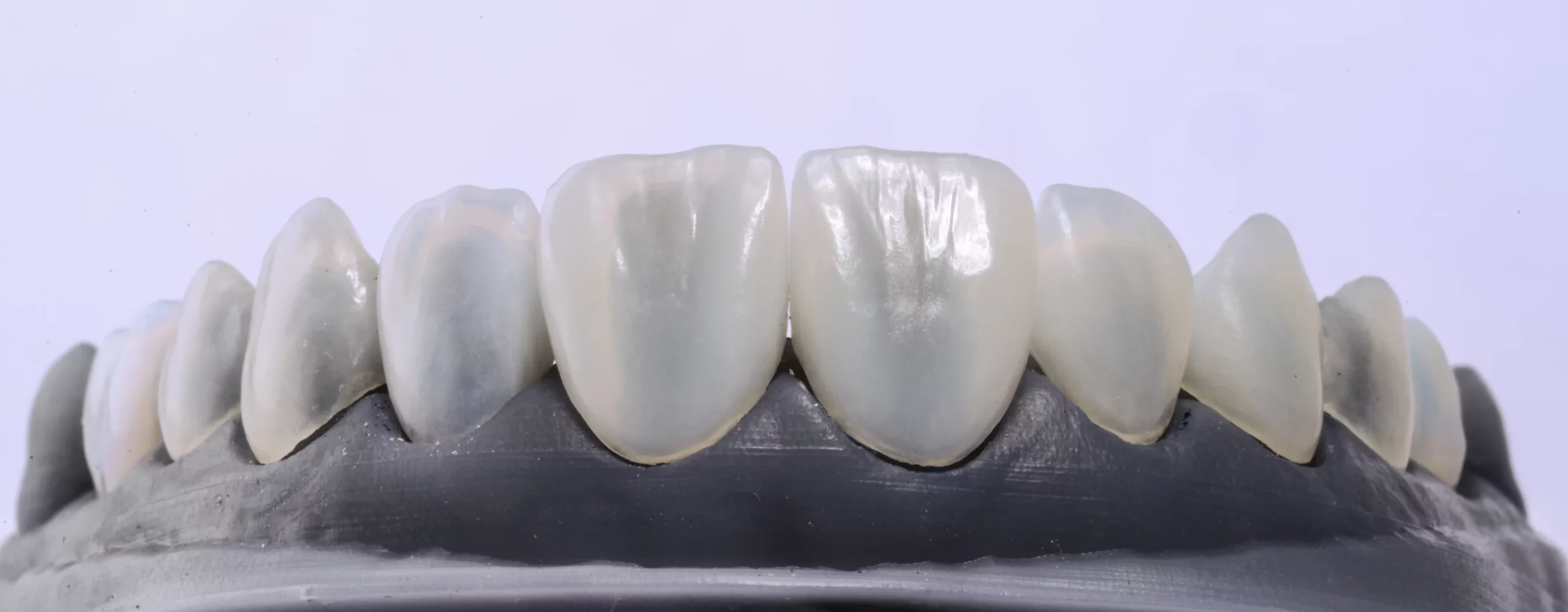 Model szczęki z kompletem estetycznych licówek porcelanowych – efekt końcowy przed założeniem u pacjenta.