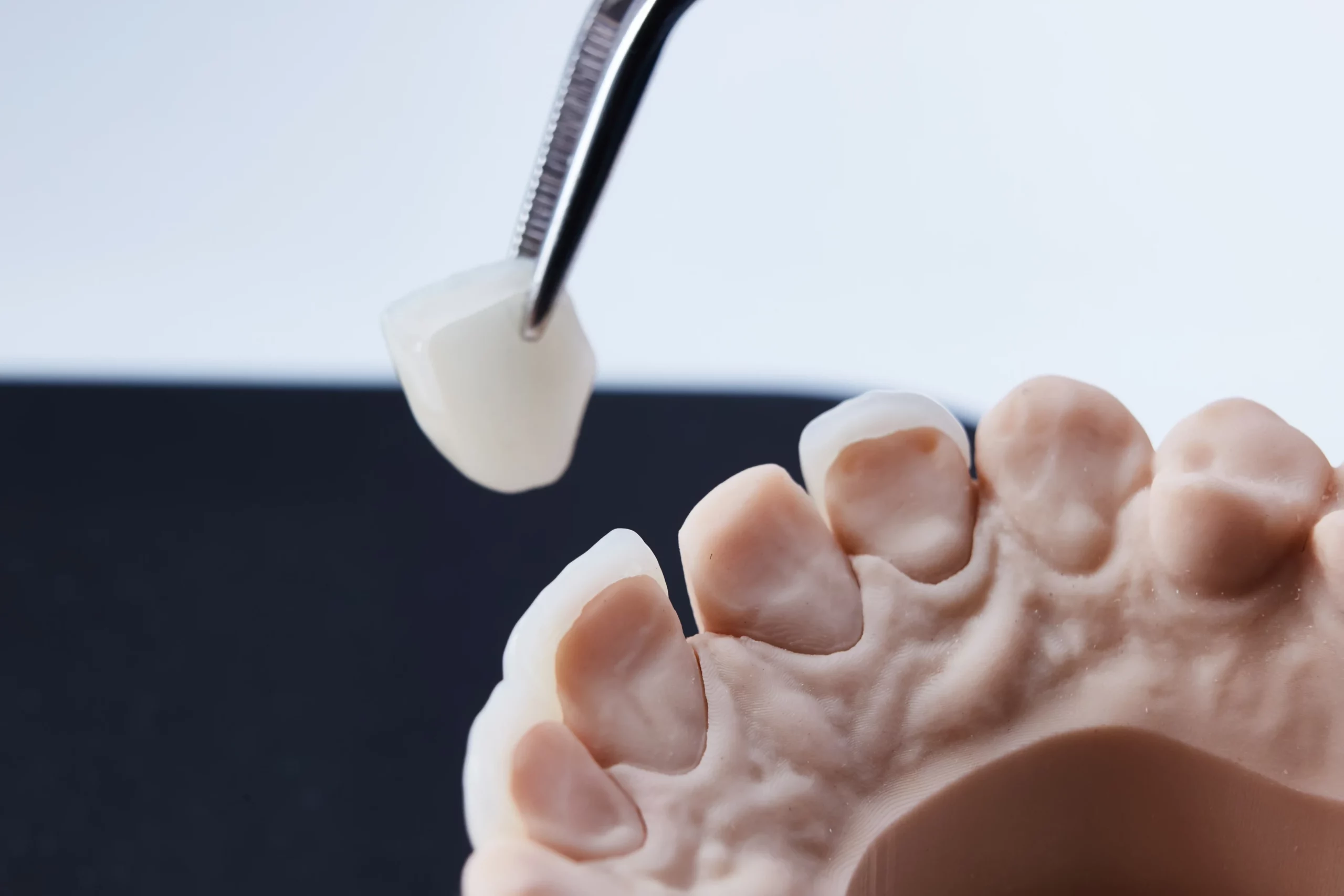 Model szczęki z widocznym przygotowaniem pod licówkę – pęseta trzymająca ceramiczną licówkę przed nałożeniem na ząb.