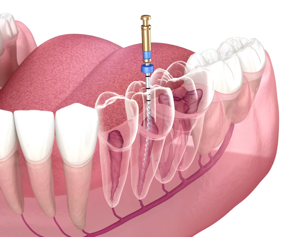 leczenie kanałowe zęba trzonowego – narzędzie endodontyczne w kanale zęba, pokazane przekrojowo, z widoczną strukturą korzeni.