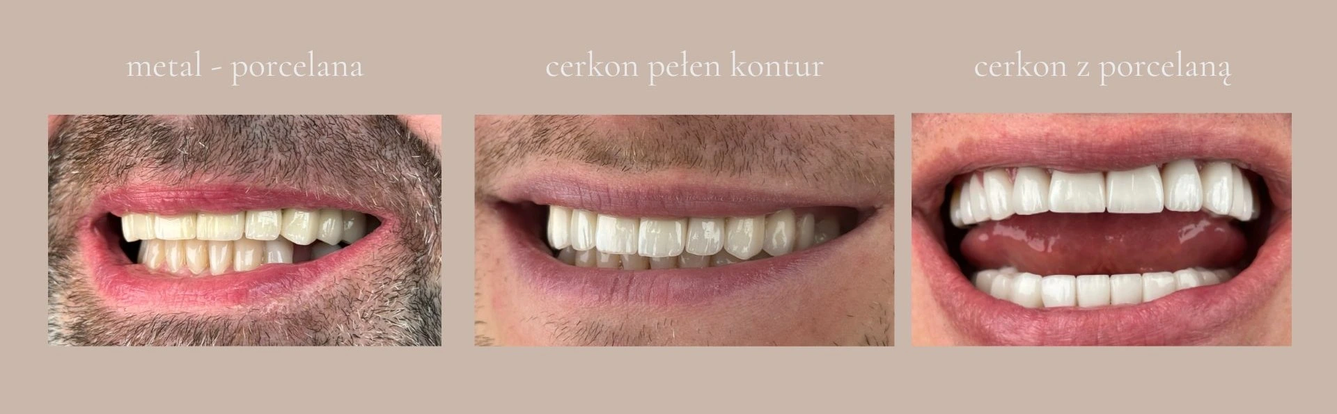 Zbliżenia uśmiechu mężczyzny prezentujące trzy rodzaje koron protetycznych: metalowo-porcelanowe, pełnoceramiczne (cyrkon pełen kontur) oraz cyrkonowe z porcelaną.