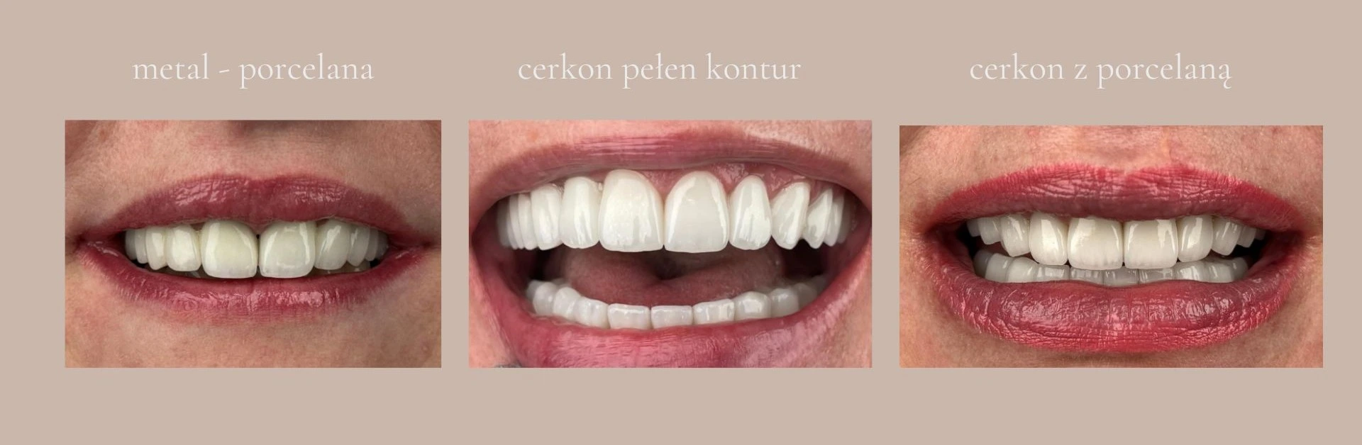 Porównanie trzech rodzajów koron protetycznych na zębach pacjentek: metalowo-porcelanowych, pełnoceramicznych (cyrkon pełen kontur) oraz cyrkonowych z porcelaną.