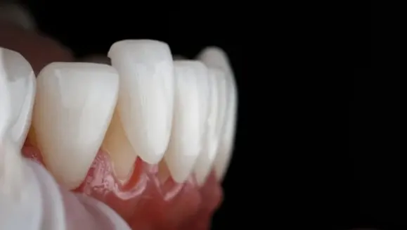 Zbliżenie na licówki ceramiczne na przednich zębach – efekt estetycznego leczenia stomatologicznego.
